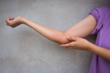 10 najčastejších mýtov o atopickom ekzéme alebo urobte si v tom jasno