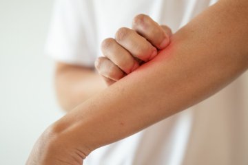 Jak se zbavit atopického ekzému a zmírnit jeho nepříjemné projevy