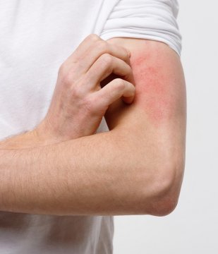 Kožné vyrážky - prečo vznikajú a aké sú najčastejšie druhy?